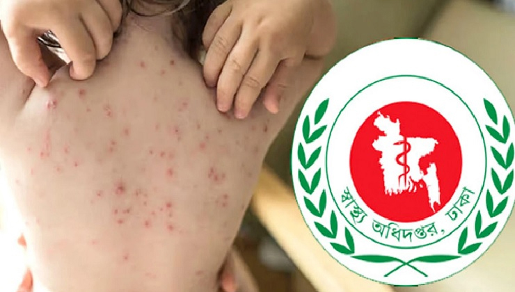 হামের উপসর্গে আরও ৭ মৃত্যু, মোট মৃত ১ হাজার ৯